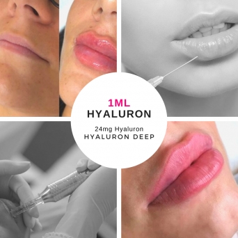 Hyaluron Deep Fertigspritze Falten & Lippenvolumen 1ml